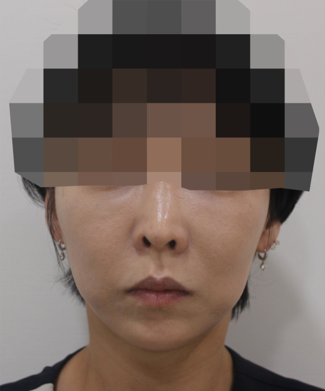 Full Face Lifting 시술 2주 후