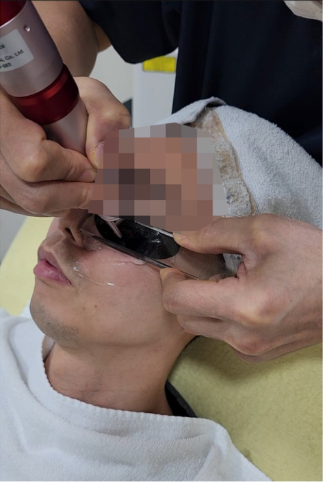 압박렌즈와 핸드피스 팁 근접 장면