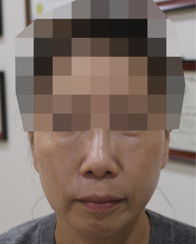 눈밑 지방 사례 시술 5주 후 사진