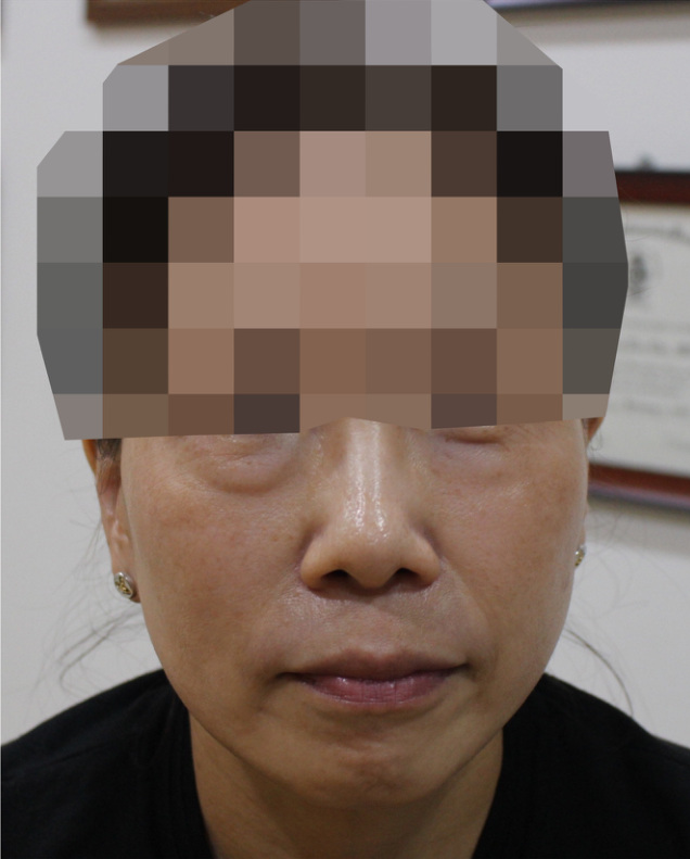 눈밑 지방 사례 시술 전 사진
